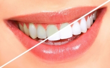 Професійне відбілювання зубів: найкращий шлях до білосніжної усмішки