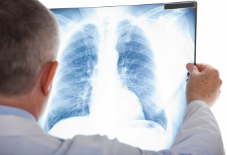 П'ять фактів про туберкульоз, про які слід знати кожному 