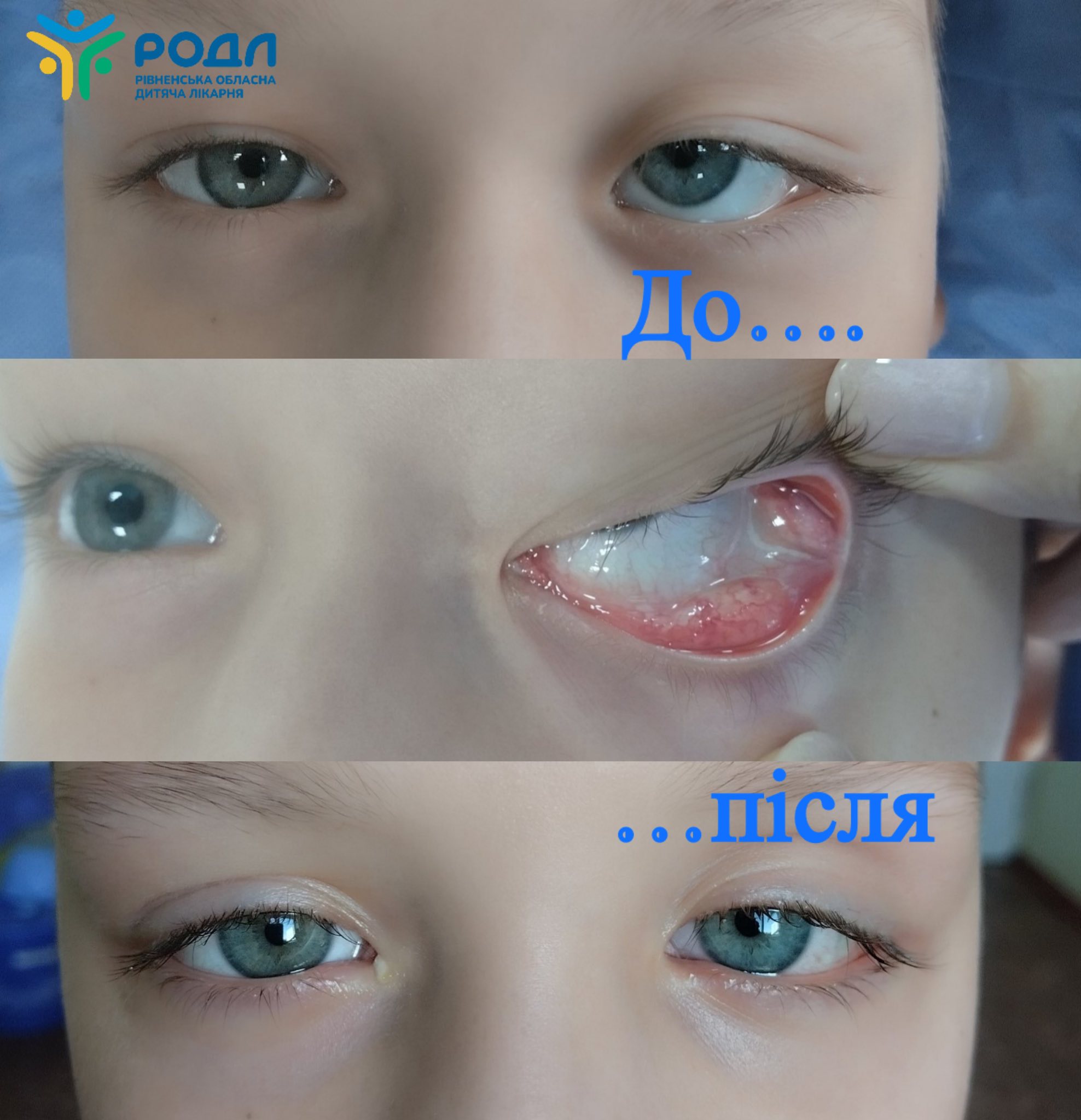 Рівненські лікарі провели складну операцію дитині з пухлиною в очниці