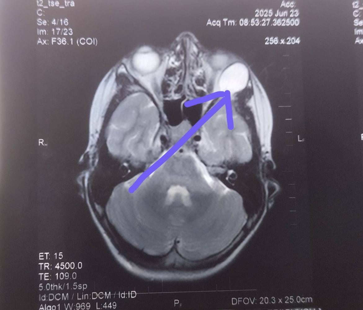 Рівненські лікарі провели складну операцію дитині з пухлиною в очниці