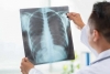 На 80% уражені легені в чотирьох пацієнтів рівненської лікарні