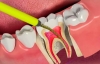 Удаление нерва зуба и его последствия