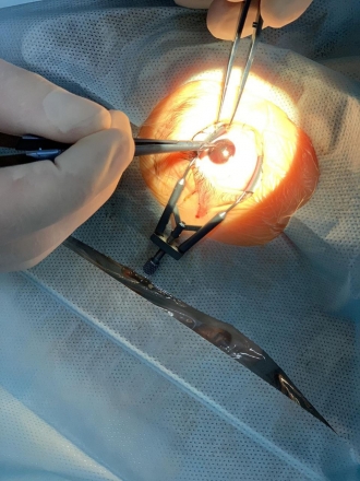 У Рівному медики врятували зір 5-річній дитині, яка проколола око манікюрними ножицями