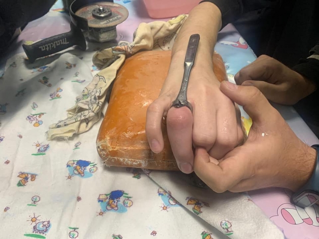 14-річному підлітку зрізали сталеве кільце з пальця (ВІДЕО)