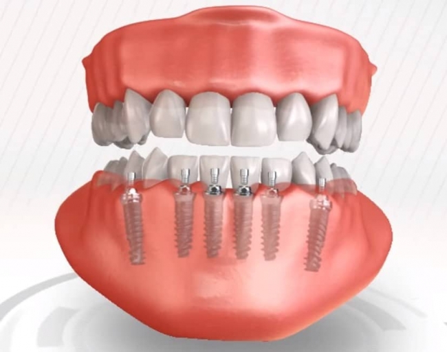Имплантация зубов all-on-6: особенности технологии в стоматологии