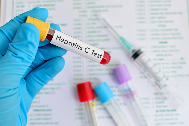 Лікування вірусного гепатиту С в Рівному – безкоштовне